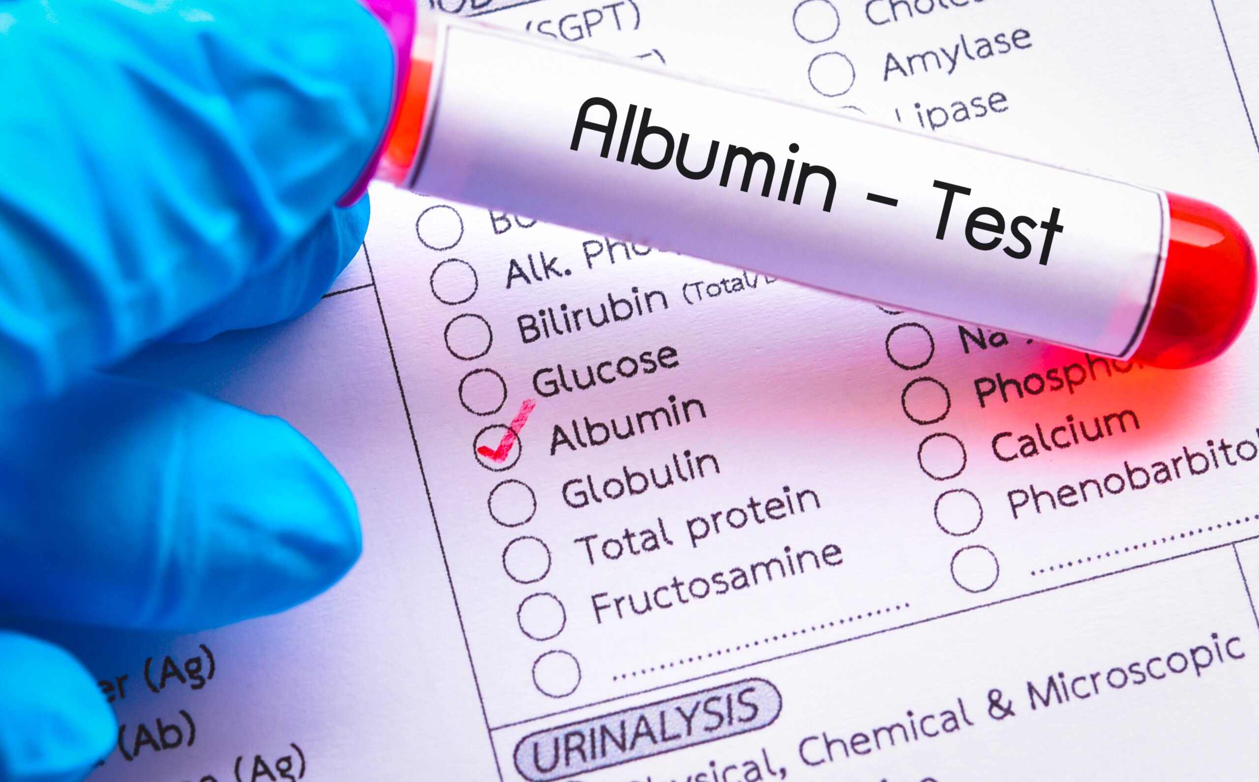 Test tube holdingg albumin serum for testing labelled as albumin