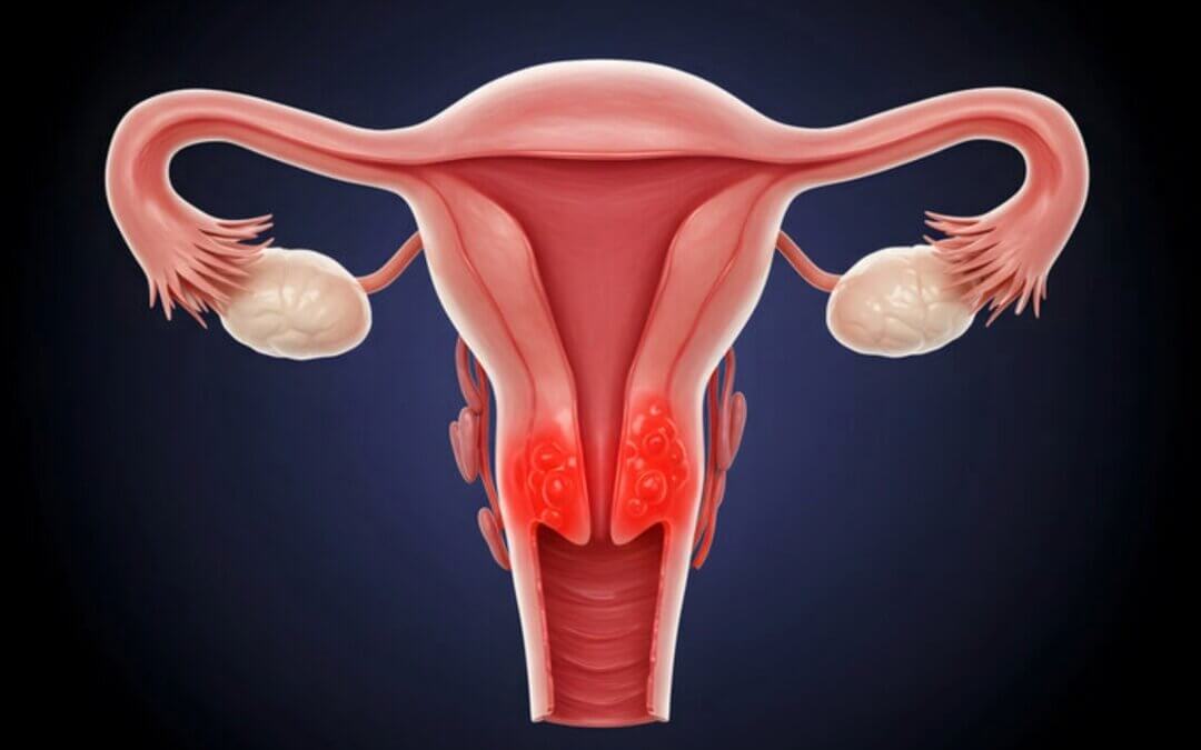 Ovarian cancer: What Every Woman Should Know | Docty Clinics
