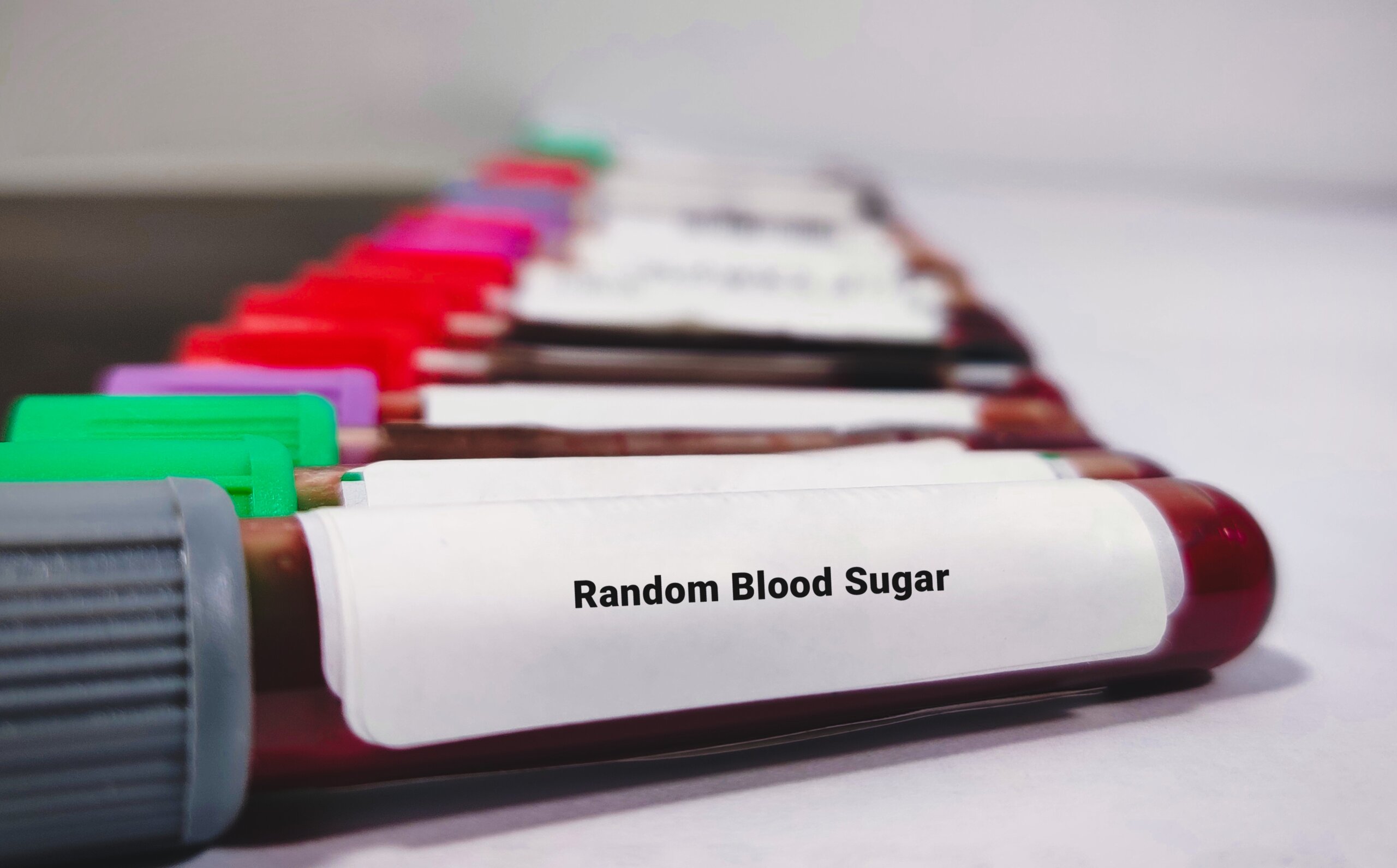Random Blood Sugar Test Tube